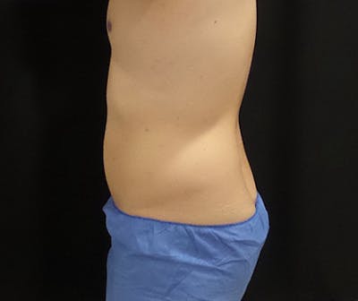 Male CoolSculpting Before & After Gallery - Patient 240570 - Image 2