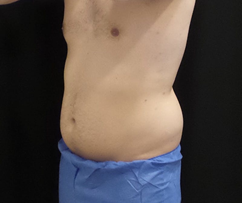 Male CoolSculpting Before & After Gallery - Patient 240570 - Image 3