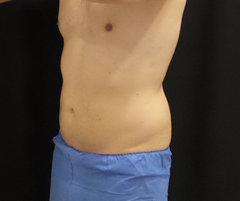 Male CoolSculpting Before & After Gallery - Patient 240570 - Image 4