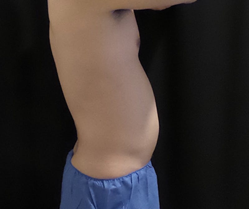 Male CoolSculpting Before & After Gallery - Patient 315950 - Image 1