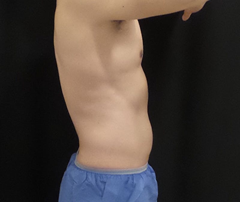 Male CoolSculpting Before & After Gallery - Patient 315950 - Image 2