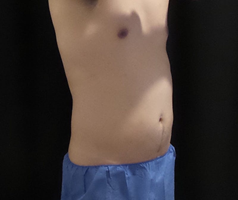 Male CoolSculpting Before & After Gallery - Patient 315950 - Image 3