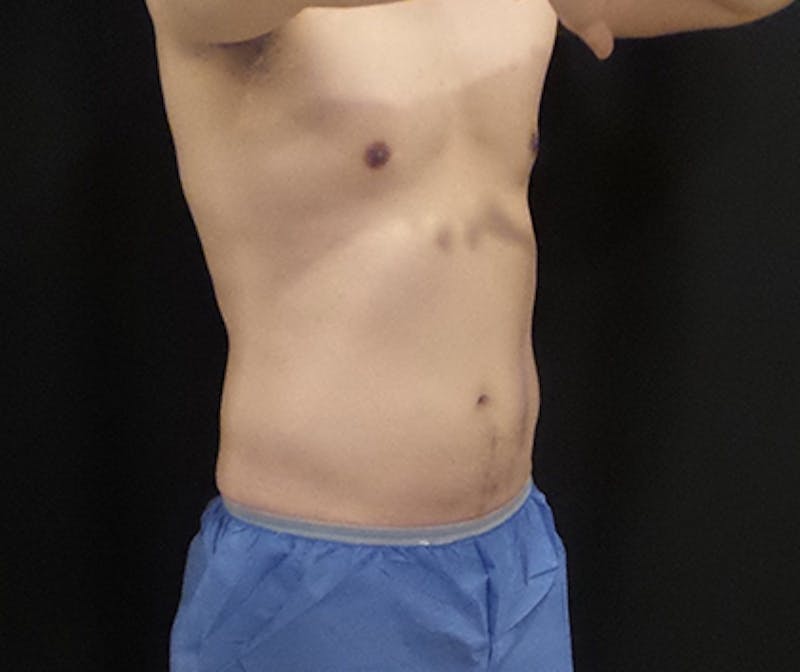Male CoolSculpting Before & After Gallery - Patient 315950 - Image 4