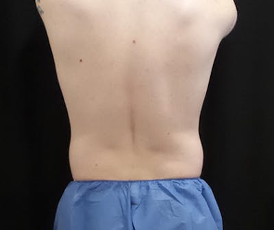 Male CoolSculpting Before & After Gallery - Patient 121988 - Image 1