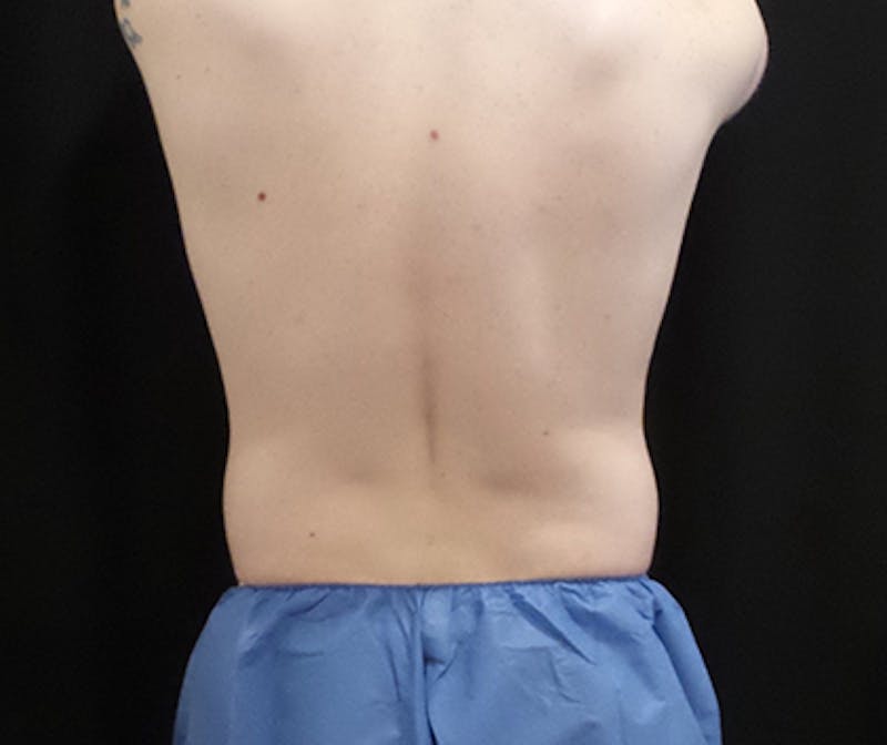 Male CoolSculpting Before & After Gallery - Patient 121988 - Image 1