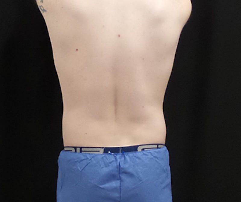 Male CoolSculpting Before & After Gallery - Patient 121988 - Image 2