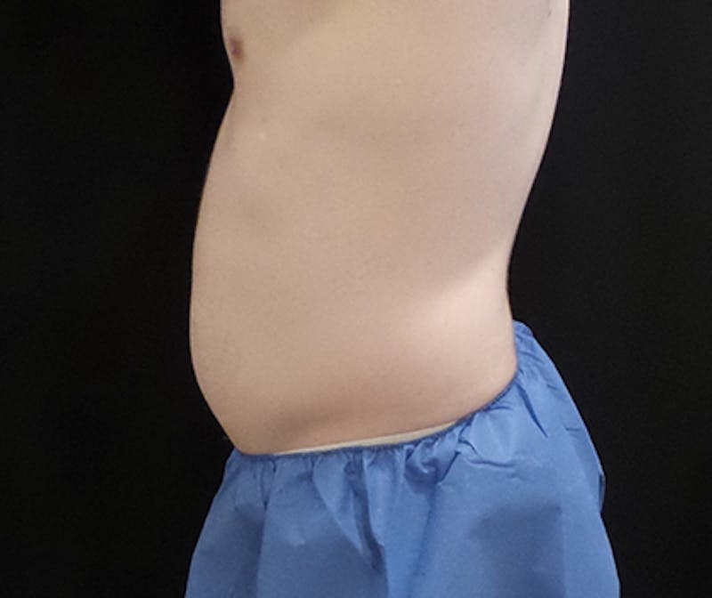 Male CoolSculpting Before & After Gallery - Patient 121988 - Image 3