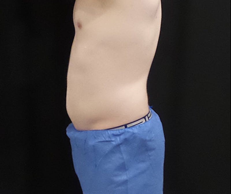 Male CoolSculpting Before & After Gallery - Patient 121988 - Image 4
