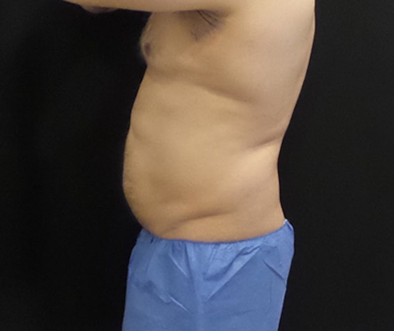 Male CoolSculpting Before & After Gallery - Patient 420463 - Image 1