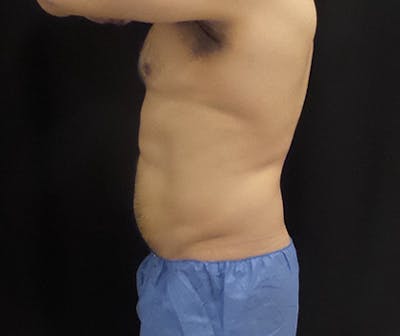 Male CoolSculpting Before & After Gallery - Patient 420463 - Image 2