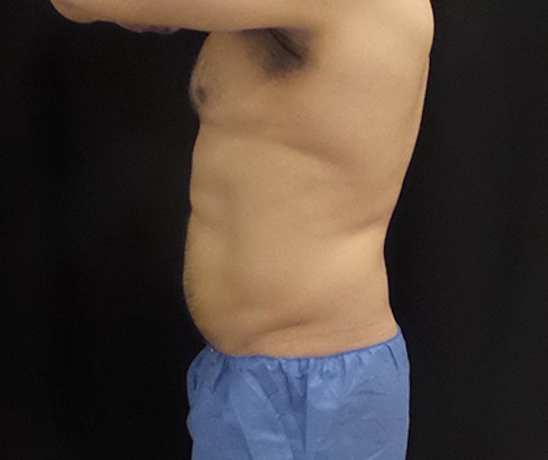Male CoolSculpting Before & After Gallery - Patient 420463 - Image 2