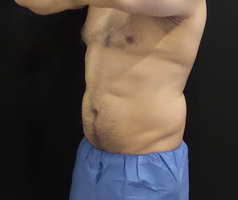 Male CoolSculpting Before & After Gallery - Patient 420463 - Image 3