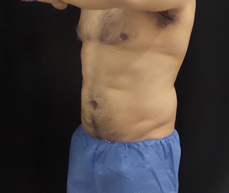 Male CoolSculpting Before & After Gallery - Patient 420463 - Image 4