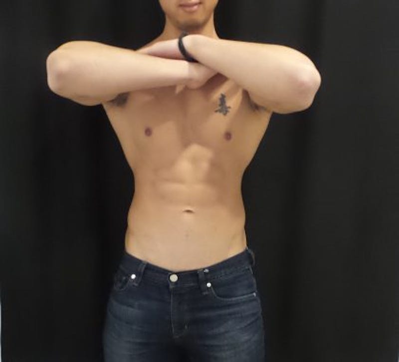Male CoolSculpting Before & After Gallery - Patient 100092 - Image 2