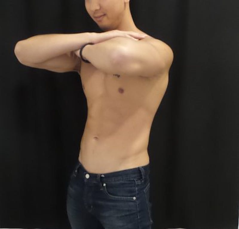 Male CoolSculpting Before & After Gallery - Patient 100092 - Image 4
