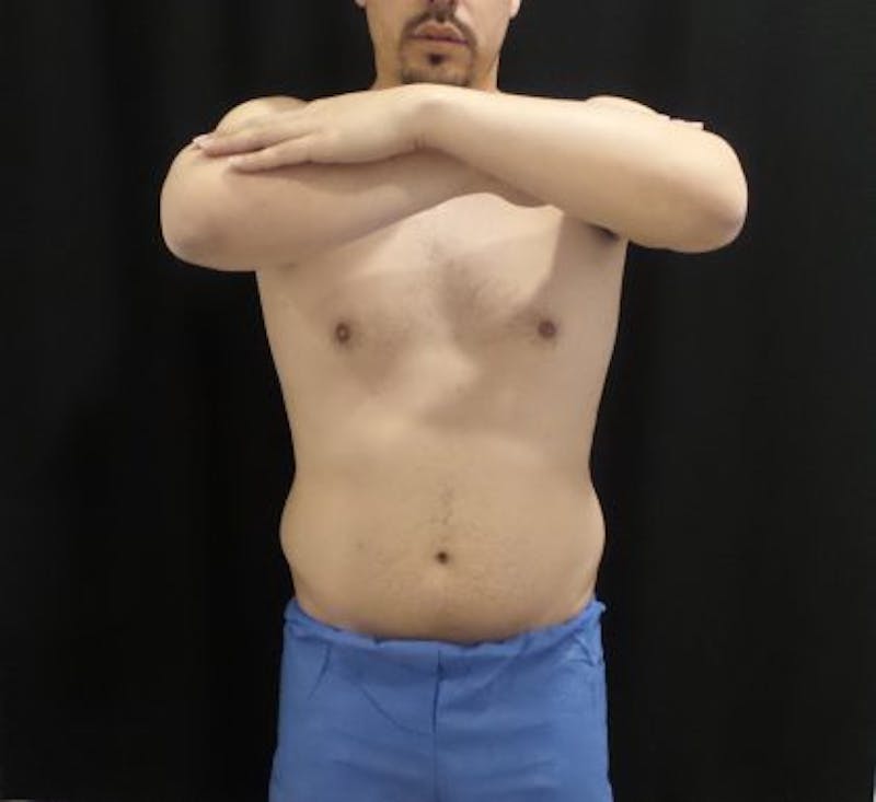 Male CoolSculpting Before & After Gallery - Patient 246386 - Image 1