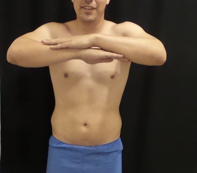 Male CoolSculpting Before & After Gallery - Patient 246386 - Image 2