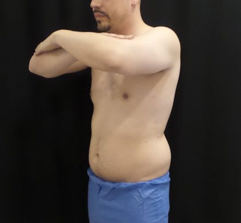 Male CoolSculpting Before & After Gallery - Patient 246386 - Image 3