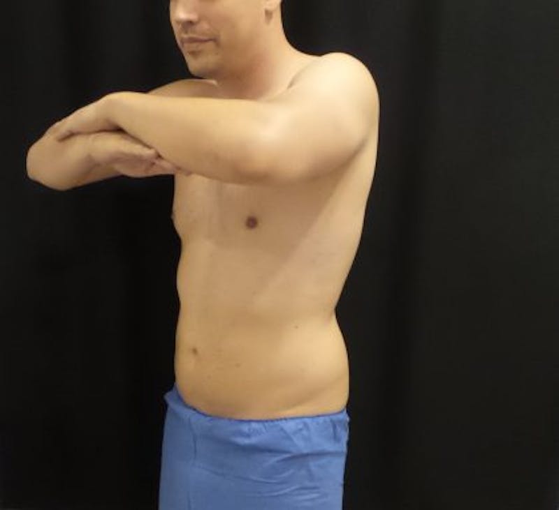 Male CoolSculpting Before & After Gallery - Patient 246386 - Image 4