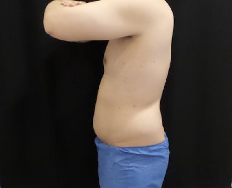 Male CoolSculpting Before & After Gallery - Patient 246386 - Image 5