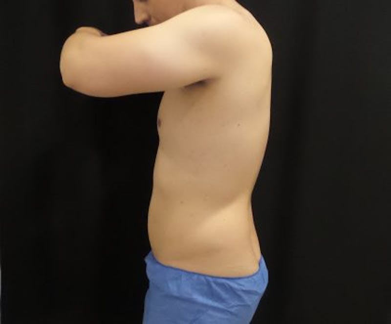 Male CoolSculpting Before & After Gallery - Patient 246386 - Image 6
