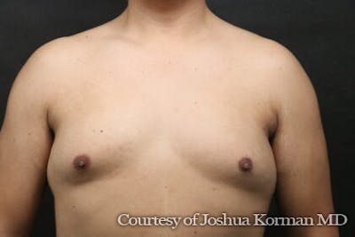 Male Breast Reduction (Gynecomastia) Before & After Gallery - Patient 122283 - Image 1