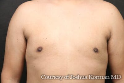Male Breast Reduction (Gynecomastia) Before & After Gallery - Patient 122283 - Image 2