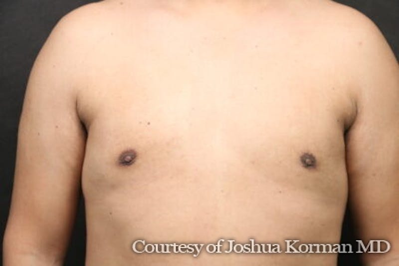 Male Breast Reduction (Gynecomastia) Before & After Gallery - Patient 122283 - Image 2