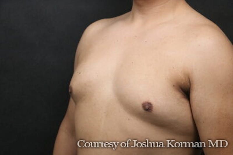 Male Breast Reduction (Gynecomastia) Before & After Gallery - Patient 122283 - Image 3