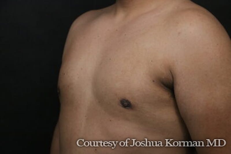 Male Breast Reduction (Gynecomastia) Before & After Gallery - Patient 122283 - Image 4