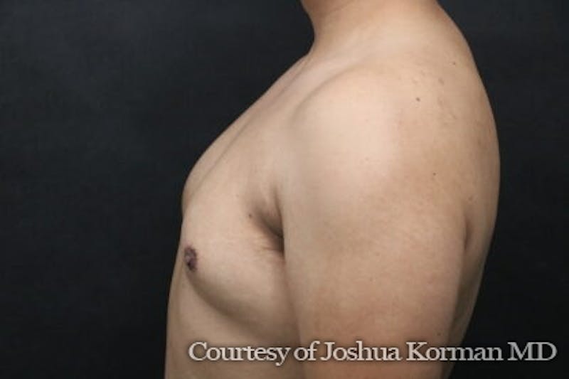 Male Breast Reduction (Gynecomastia) Before & After Gallery - Patient 122283 - Image 5