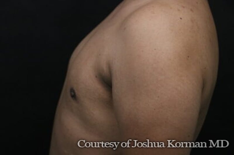 Male Breast Reduction (Gynecomastia) Before & After Gallery - Patient 122283 - Image 6