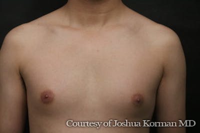 Male Breast Reduction (Gynecomastia) Before & After Gallery - Patient 113726 - Image 1