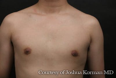 Male Breast Reduction (Gynecomastia) Before & After Gallery - Patient 113726 - Image 2