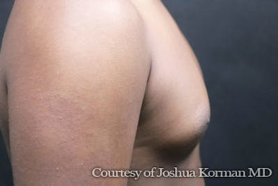 Male Breast Reduction (Gynecomastia) Before & After Gallery - Patient 415703 - Image 1