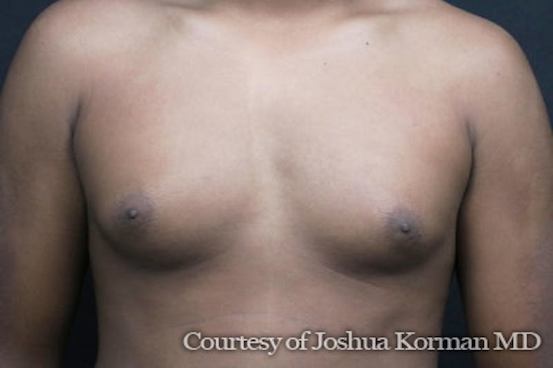 Male Breast Reduction (Gynecomastia) Before & After Gallery - Patient 415703 - Image 3
