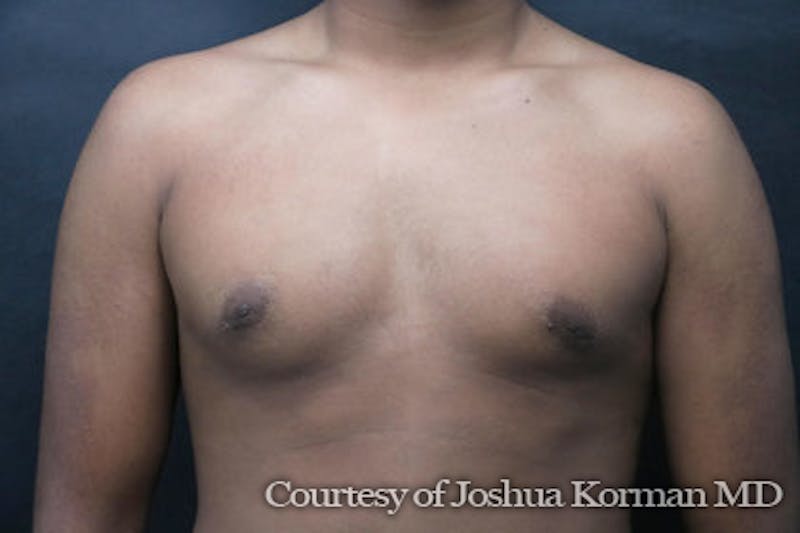 Male Breast Reduction (Gynecomastia) Before & After Gallery - Patient 415703 - Image 4