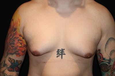 Male Breast Reduction (Gynecomastia) Before & After Gallery - Patient 372806 - Image 1