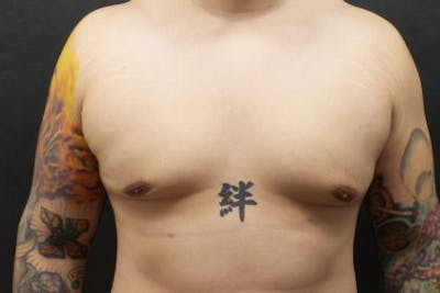 Male Breast Reduction (Gynecomastia) Before & After Gallery - Patient 372806 - Image 2
