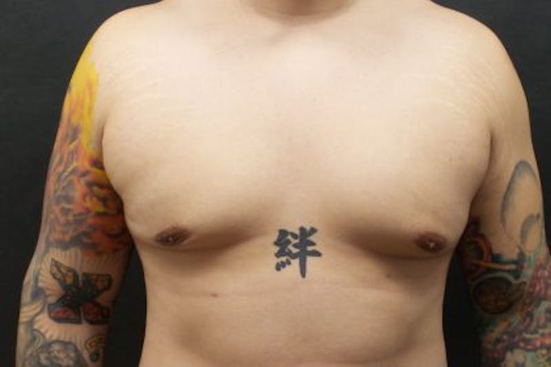 Male Breast Reduction (Gynecomastia) Before & After Gallery - Patient 372806 - Image 2