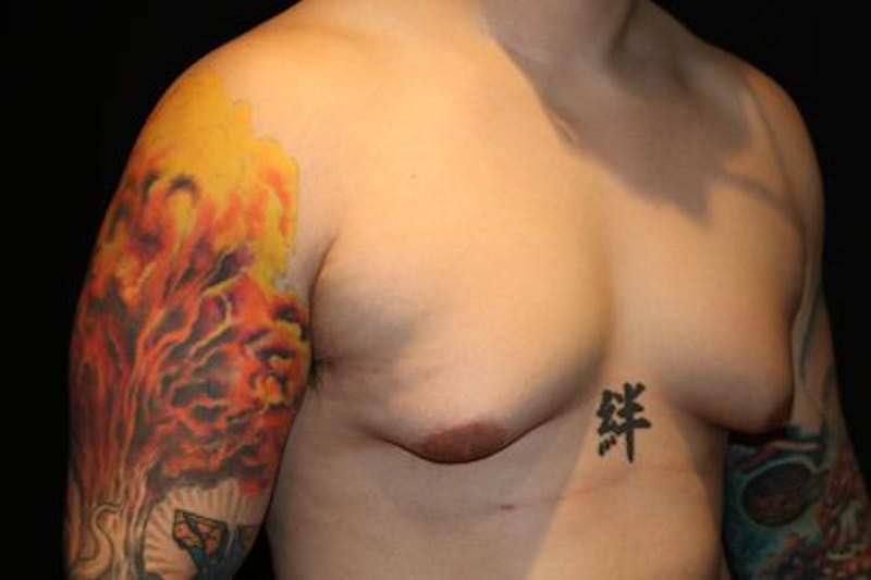 Male Breast Reduction (Gynecomastia) Before & After Gallery - Patient 372806 - Image 3