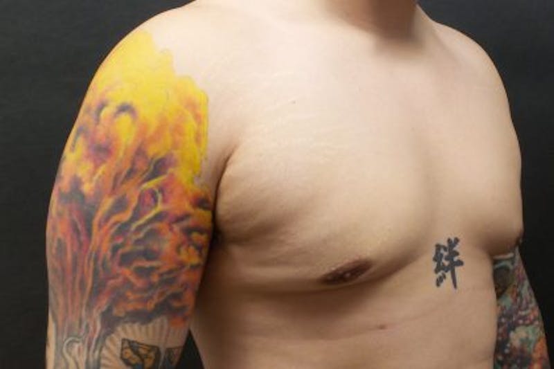 Male Breast Reduction (Gynecomastia) Before & After Gallery - Patient 372806 - Image 4