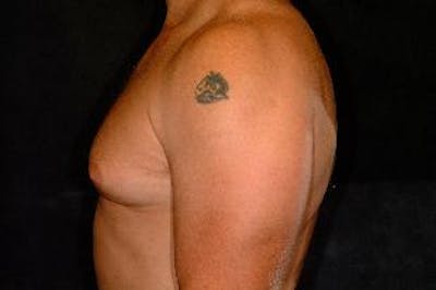 Male Breast Reduction (Gynecomastia) Before & After Gallery - Patient 207414 - Image 1