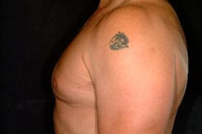 Male Breast Reduction (Gynecomastia) Before & After Gallery - Patient 207414 - Image 2