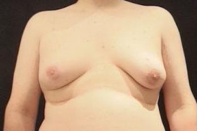Male Breast Reduction (Gynecomastia) Before & After Gallery - Patient 401086 - Image 1
