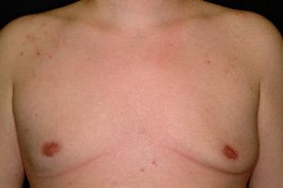 Male Breast Reduction (Gynecomastia) Before & After Gallery - Patient 401086 - Image 2