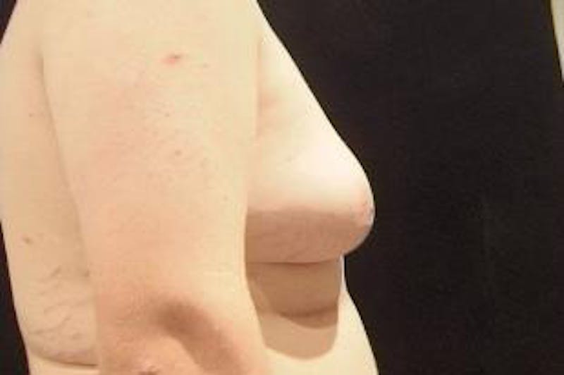 Male Breast Reduction (Gynecomastia) Before & After Gallery - Patient 401086 - Image 3