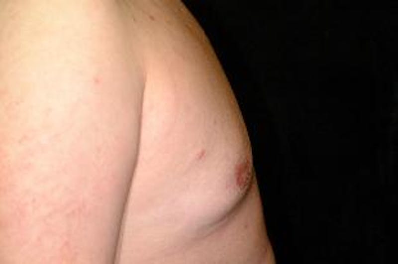 Male Breast Reduction (Gynecomastia) Before & After Gallery - Patient 401086 - Image 4