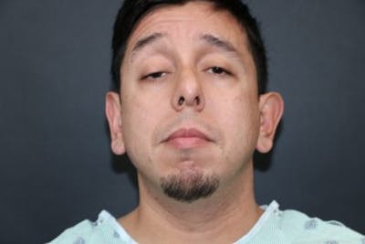 Male Otoplasty Before & After Gallery - Patient 204107 - Image 1