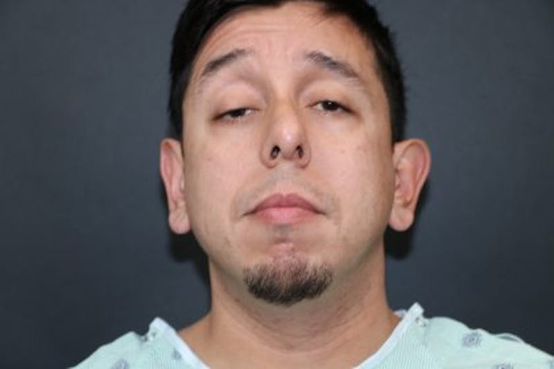 Male Otoplasty Before & After Gallery - Patient 204107 - Image 1